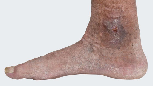 כיבים ברגליים – Leg ulcers
